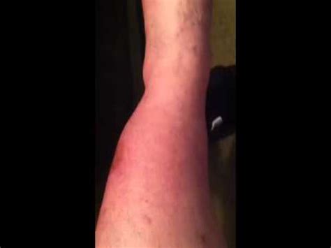 A blood clot in the arm can be a dangerous health problem. Dvt blood clot swelling - YouTube