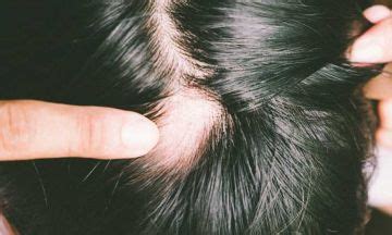 You can expect the hair to slowly fill back in over the next several months. Can alopecia areata be treated? | Dr Batra's™