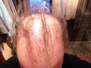 And i've been having a few hair loss. National Injury Help | Docetaxel Hair Loss Drug Risks ...
