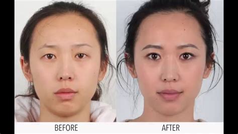 Buy double eyelid surgery services of plastic surgeon in klang malaysia — from klinik pakar kulit ko, sdn bhd in catalog allbiz! Double Eyelid Surgery - YouTube