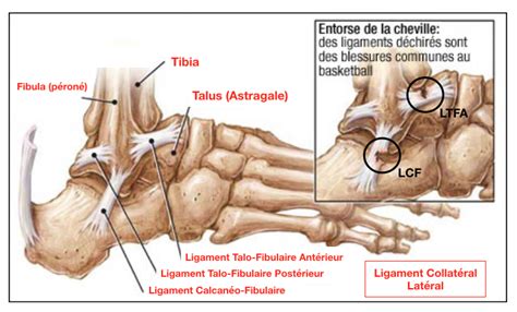 A ligament is a band of strong tissue in a person's body which connects bones. Docteur Bruno Lévy | » Entorses et ligamentoplasties de la ...