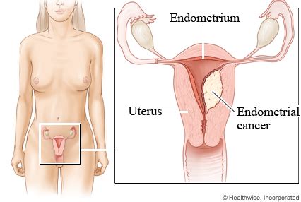 This is the lining of a woman's uterus. What exactly is UTERUS CANCER (ovaries cancer)