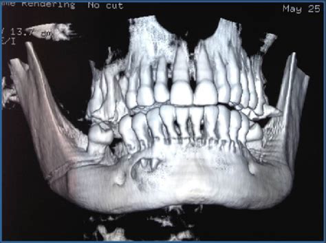 Ege üniversitesi kimya mühendisliği bölümünden mezun olduktan sonra. B. 3D reconstruction of the mandible showing perforation ...