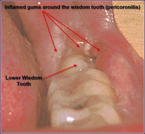 Exercise is not suggested at this time because you may. FAMILY CARE DENTAL: WISDOM TEETH