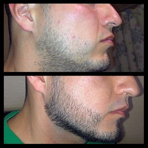 To answer this question you need to understand a few basics to hair growth and loss. Minoxidil Beard Growth: Real Before and After Photos