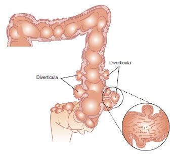 To determine whether computed tomographic (ct) perfusion measurements in prospectively recruited patients can be used to differentiate between diverticulitis and colorectal cancer and to compare this discrimination with that of standard morphologic criteria. Colon Surgery - Dr. Scott Laker - Michigan Surgery