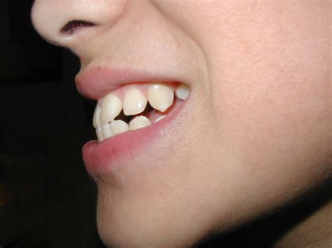 You can trust it, it's firsthand information. How to Tell If You Have an Overbite - how to tell if