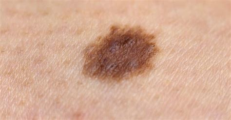 • the skin lesions of a local recurrence may ulcerate or. Is it normal for a new mole to appear? Causes and warning ...