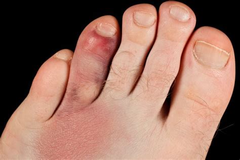 Yes, it's a regional varient of a stubbed finger. Broken toe - NHS.UK
