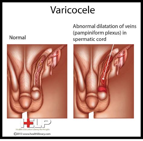 Varicoceles are not usually serious, but complications include fertility problems. Varicocele | Medical knowledge, Plexus products ...