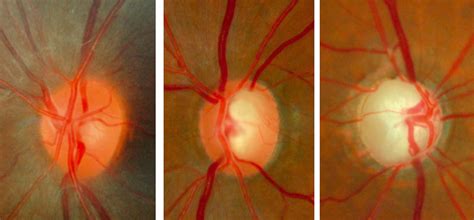 Optic nerve, once damaged, whatever the primary cause be, cannot be treated neither medically nor there can be many causes for optic nerve damage or optic atrophy to occur, like glaucoma. Normal optic disc and glaucomatous optic nerve heads of tw ...