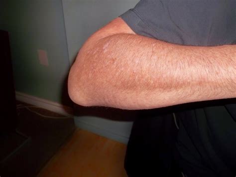 Both septic and nonseptic olecranon bursitis can present with bursa swelling, redness, and pain to palpation. DOGBRINDLE.COM : Olecranon Bursitis — Commonly Known As Popeye's Elbow