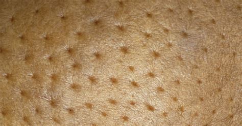 Inflammatory breast cancer isn't a rash. WebMD on Twitter: "Inflammatory breast cancer rarely ...