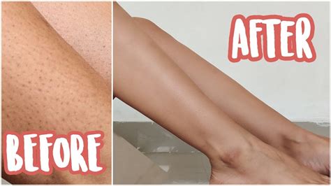 Some types of hair are more prone to ingrowns. How to get rid of strawberry legs + ingrown hair | my ...