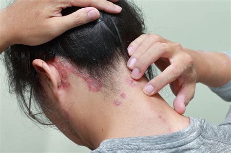 This article discusses some natural cures that could help heal scalp psoriasis. scalp psoriasis back of neck and ear - Psoriasis Cure Now