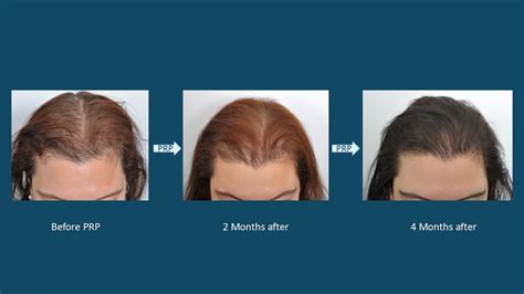 This is called telogen effluvium. Hair Loss Treatments (Non-Surgical) For Women - Dr. David ...