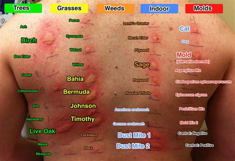 In an allergy skin test for a food, a food allergy testing is a very important step in diagnosing food allergies. Ajit Vadakayil: ALLERGY , THE OVERKILL RESPONSE OF ...