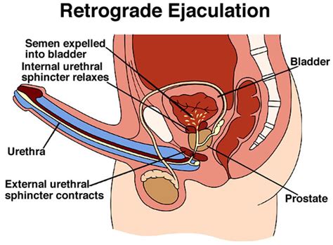 Prostate massage increases the flow of blood which helps in flushing out those bacteria. Gay Forums - Sexual Health - Retrograde Ejaculation ...