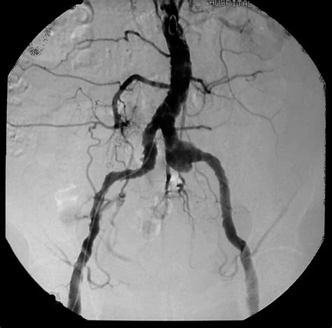 Un aneurisma es una pequeña protuberancia con forma de globo y llena de sangre que se forma en las paredes de los vasos sanguíneos. File:Aneurisma micótico de la arteria ilíaca izquierda.jpg ...