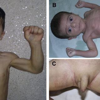 Since berardinelli described a very rare case of congenital generalized lipodystrophy. Amirreza Haghighi | Doctor of Medicine | University of ...