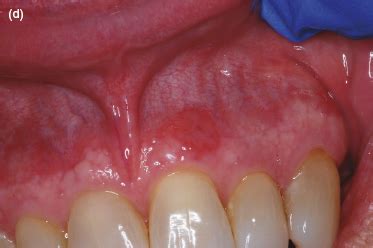 Leukoplakia is a condition where white patches or lesions appear in the mouth. 3: Common Oral Soft Tissue Lesions | Pocket Dentistry