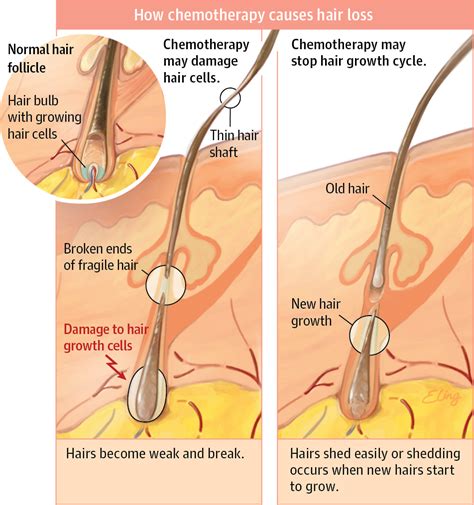 There are many different causes of alopecia, some it works better in men or women who have a general thinning of the hair. Chemotherapy and Hair Loss | Hair Disorders | JAMA | The ...