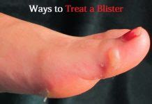 To treat a blister it's recommended that you do not puncture it. How to Treat a Foot Blister?