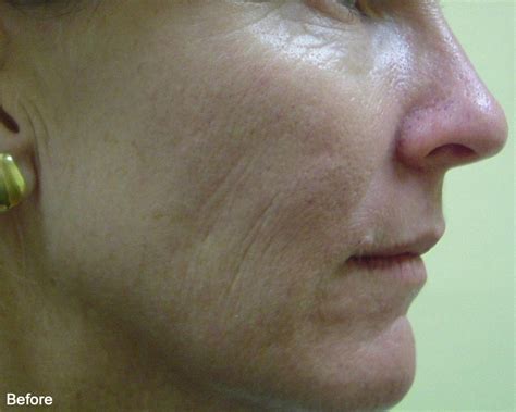 Skin Rejuvenation | Sutherland Skin Cancer & Laser Clinic ...