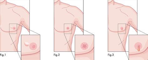 5 ﻿ while other types of lung cancer often have no symptoms in the early stags, these tumors that directly impact the airways may cause persistent coughing, or you may even begin coughing up blood early on. Male Breast Cancer Signs, Symptoms, Treatment