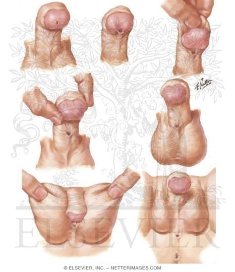 Hypospadias refers to a birth defect of the male urethra where the urinary opening is not on the head of the penis. علاج اعوجاج القضيب بدون جراحة في حال إذا كان الاعواج ...