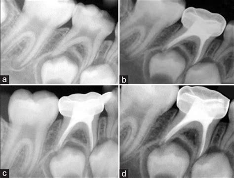 „ administer local „ isolate „ excavate caries. Single- versus two-visit pulpectomy treatment in primary ...