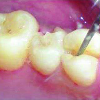 This extra cusp is usually found on the second molar, and becomes progressively less likely in the first, third molars. Oblique fracture of distofacial cusp with 16 with loss of ...