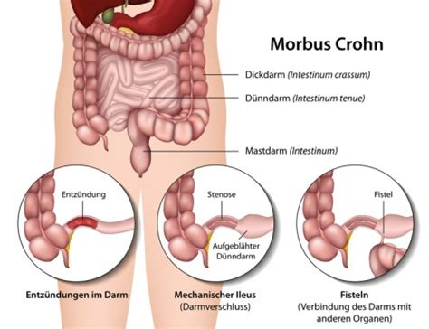 Blut im stuhl ist in den meisten fällen mit dem bloßen auge erkennbar. Darm - Funktion, Aufbau & Beschwerden | Gesundpedia.de