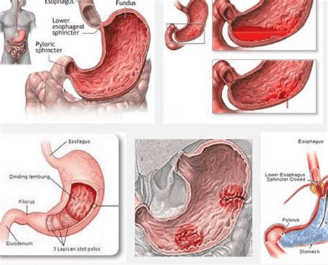 Sedangkan kegagalan fungsi karena imobilitas, kelemahan otot dan gangguan neuromuskular akan menyulitkan kebutuhan akan defekasi. Gastritis Merupakan Panyakit Karena Gangguan ? : Mencegah ...