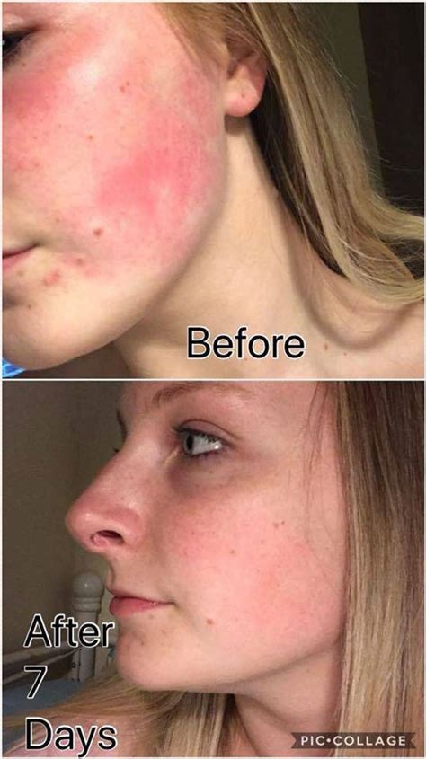 Review trulum vs pratista untuk bopeng bekas jerawat dan flek hitam di wajah. Trulum Skincare - Fitness With Ulrika