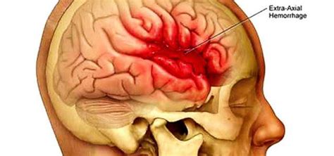 L'emorragia cerebrale è una sindrome neurologica acuta dovuta alla rottura di un vaso arterioso cerebrale e al conseguente stravaso di sangue nel parenchima cerebrale. Emorragia cerebrale, cos'è la sindrome di Lele Spedicato ...