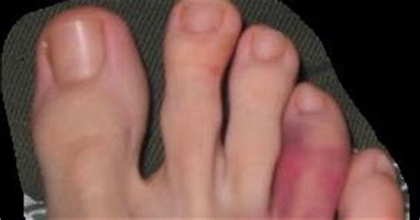 Finger jam jammed finger is a term that refers to the many injuries of the ligaments and soft tissue around it doesn't matter whether you've jammed a finger blocking a spike or just stubbed your toe. Treatment of Toe Injuries : Broken, Sprained, Fractured ...