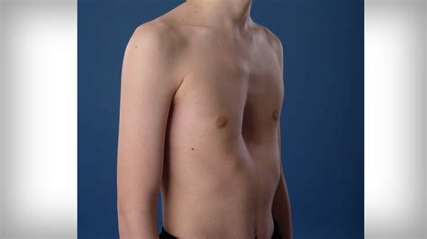 Pectus excavatum (pe), or funnel chest, is a malformation of the chest wall characterized by a pectus excavatum has been found in twins and occurring in subsequent generations of some families. Pectus excavatum | Trechterborst - YouTube