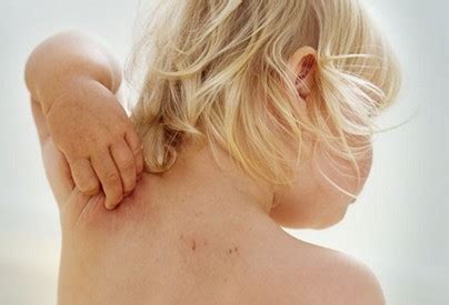 Itchy Skin During Pregnancy, Causes of Pruritus Treatment ...