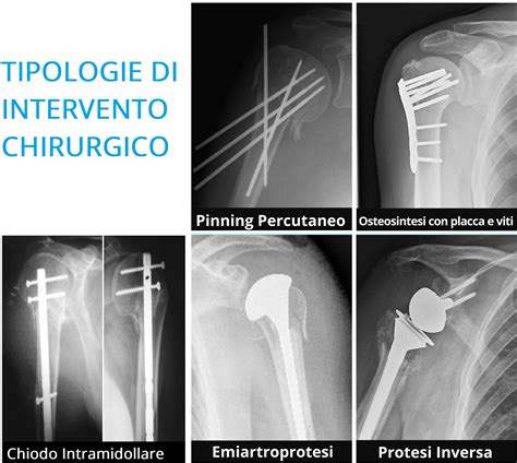 Frattura dell'Omero Prossimale