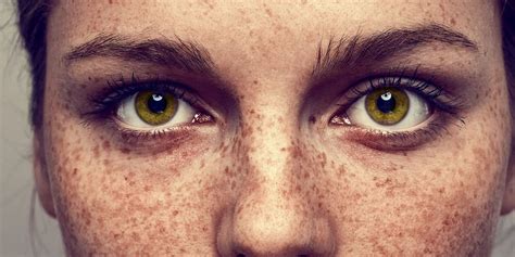 Hyperpigmentation de la peau : comment y mettre fin ? - WUFYS