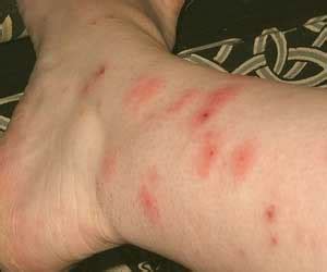 Symptoms of a hobo spider bite. What Does a Spider Bite Look Like? How to Identify a ...