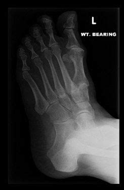 Definition • midfoot arthritis is arthritis involving the tmtj (lisfranc) and intertarsal joints. Midfoot Arthritis