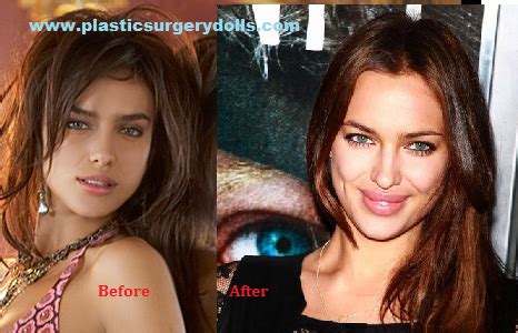 Almost everyone admires irina shayk. Pin by Haleigh York on Plastic | Lip surgery, Irina shayk ...