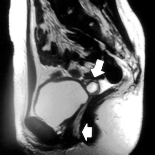 The technique described by vecchietti is a. (PDF) Non-surgical Treatment of Vaginal Agenesis Using a ...