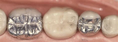 Dental amalgam is not used when: "I still think amalgam has a place in dentistry ...