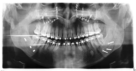 What are the treatment options? I had double jaw surgery 6 months ago. AMA! : IAmA