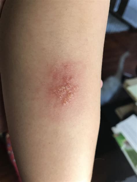 Sometimes herpes can be spread even if. Wife has recurring rash : Dermatology