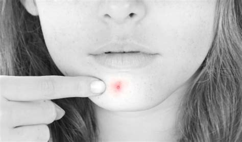 This will reduce pimple size and redness. How to Reduce Pimple Redness? - Reduce Redness of a Pimple