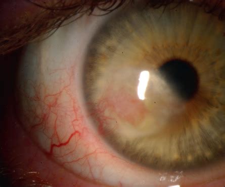 Topical therapy with acyclovir for hsv ocular infections is effective, but probably not superior to trifluridine (hovding, 1989). Herpes Simplex Keratitis | Ento Key